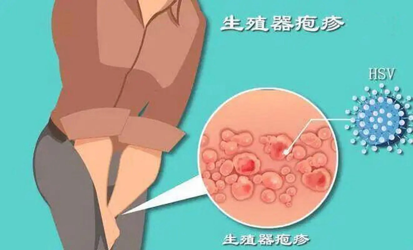 阴部单纯疱疹症状表现 阴部单纯疱疹病毒严重吗